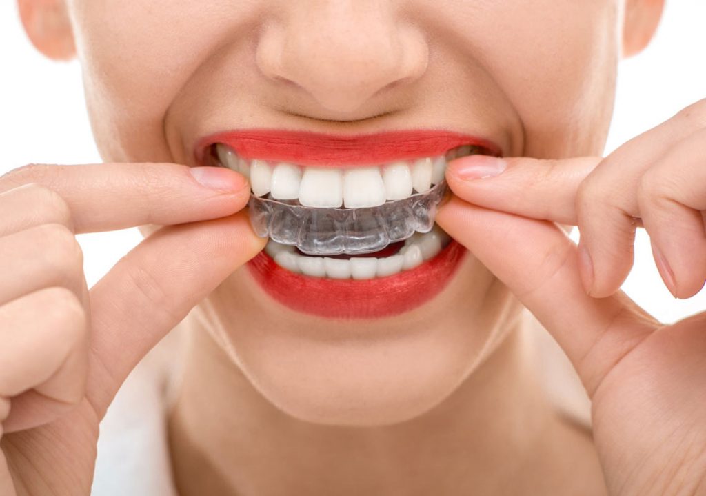 Junge Frau beim Einsetzen eines Aligners mit beiden Händen.