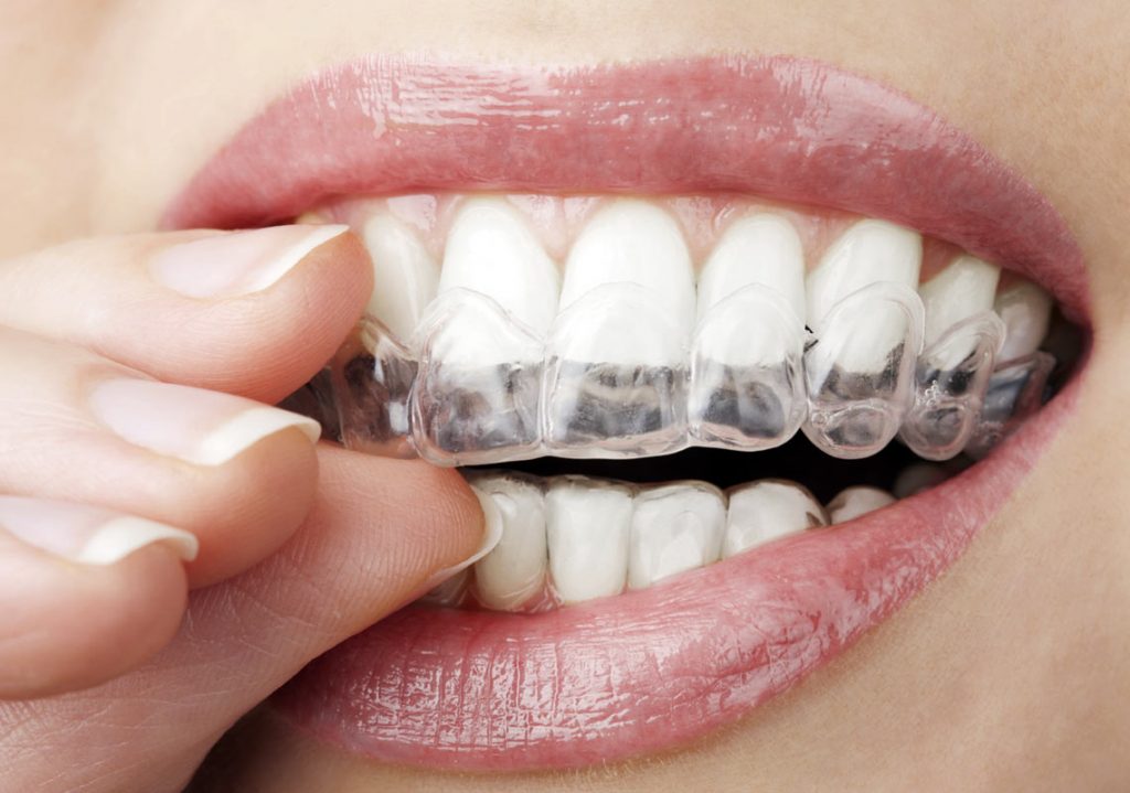Nahaufnahme eines weiblichen Mundes mit Invisalign an den Zähnen.