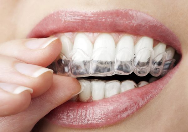 Invisalign