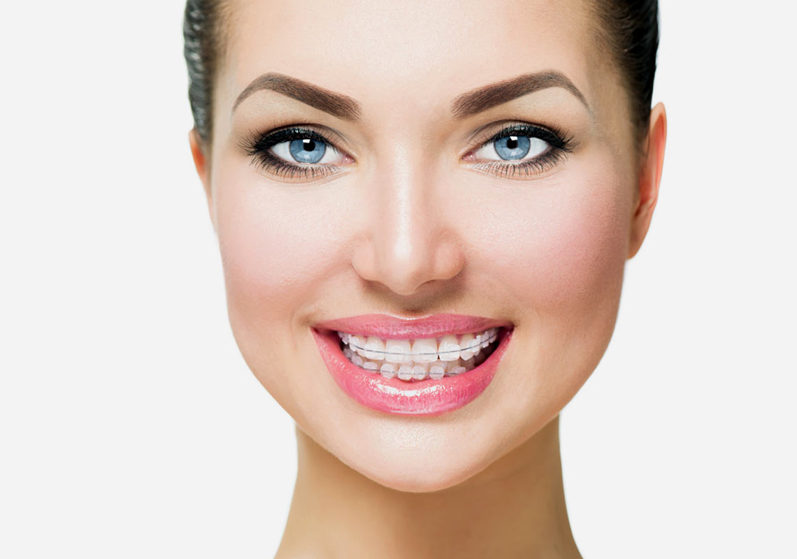 KI-generiertes Bild einer Frau mit Keramikbrackets.